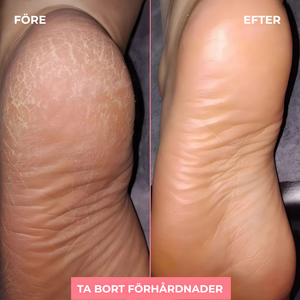 LynFot™ | Elektrisk förhårdnadsfotslip – mjuka fötter hemma