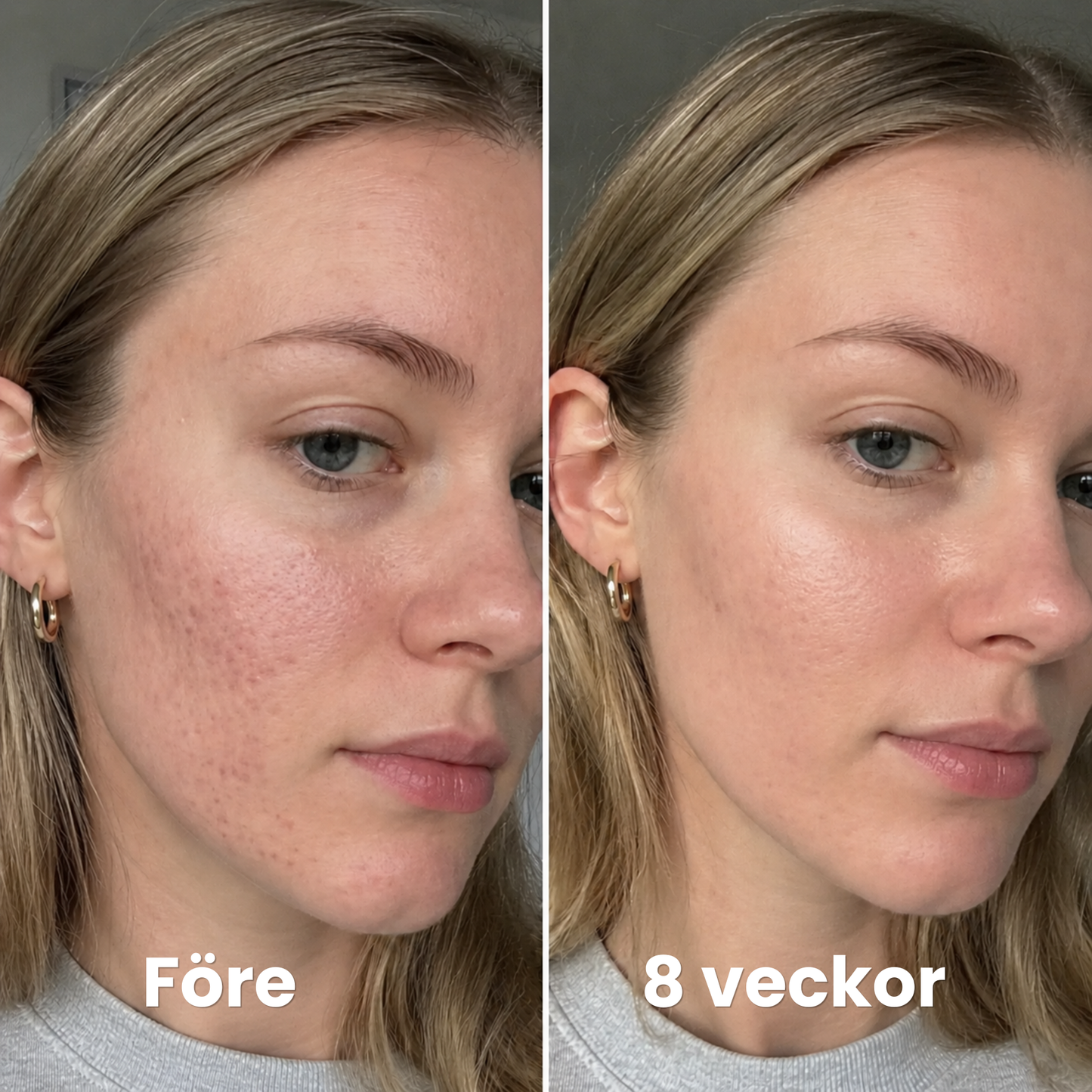 Velau™ - För akneärr & en jämnare hud